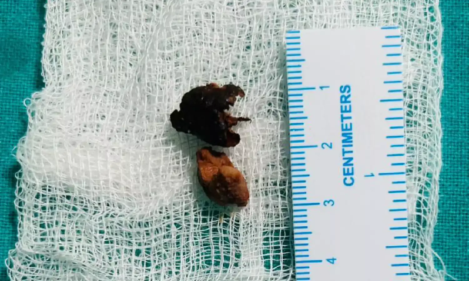 KIMS Saveera doctors in Anantapur extract betel nut lodged in woman’s lungs for over half a year