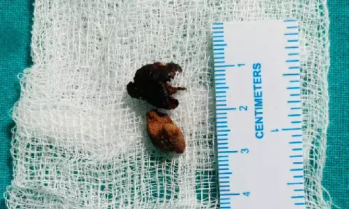 KIMS Saveera doctors in Anantapur extract betel nut lodged in woman’s lungs for over half a year