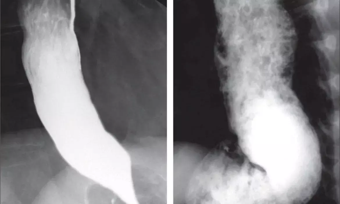 Hyderabad: Docs at KIMS perform rare endoscopic surgery on boy who was unable to swallow solid food