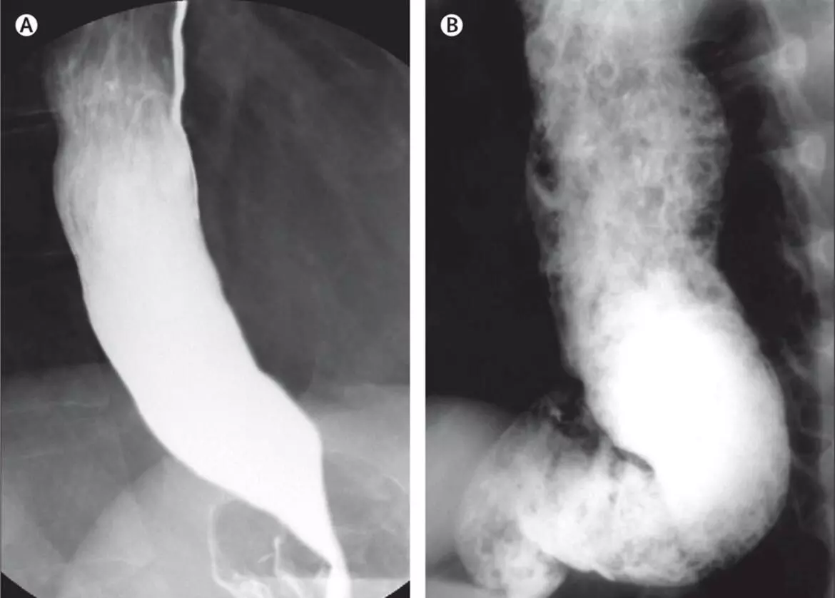 Hyderabad: Docs at KIMS perform rare endoscopic surgery on boy who was unable to swallow solid food Hyderabad: Docs at KIMS perform rare endoscopic surgery on boy who was unable to swallow solid food