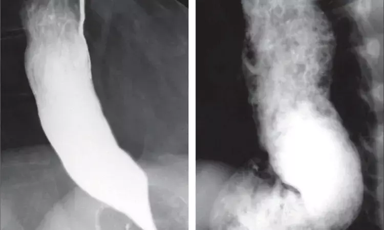 Hyderabad: Docs at KIMS perform rare endoscopic surgery on boy who was unable to swallow solid food