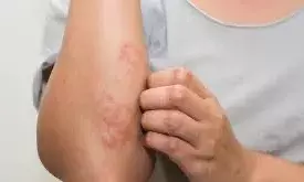 Diwali skincare guide: Firecracker safety, first aid and pollution protection