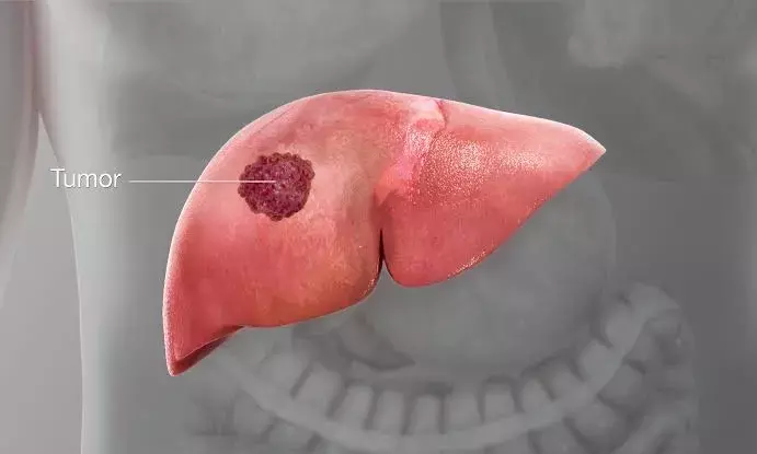Liver cancer surge: When detected early, surgery and regeneration offer hope, say experts