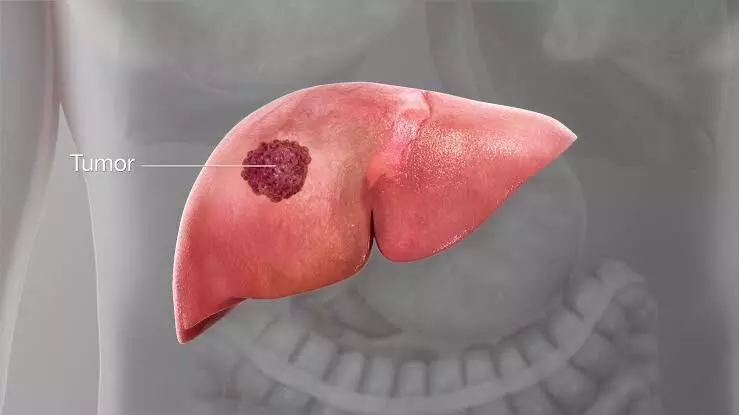 Liver cancer surge: When detected early, surgery and regeneration offer hope, say experts
