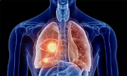 Lung Cancer Awareness Month: 1 in 101 individuals carries risk of developing lung carcinoma in India Lung Cancer Awareness Month: 1 in 101 individuals carries risk of developing lung carcinoma in India