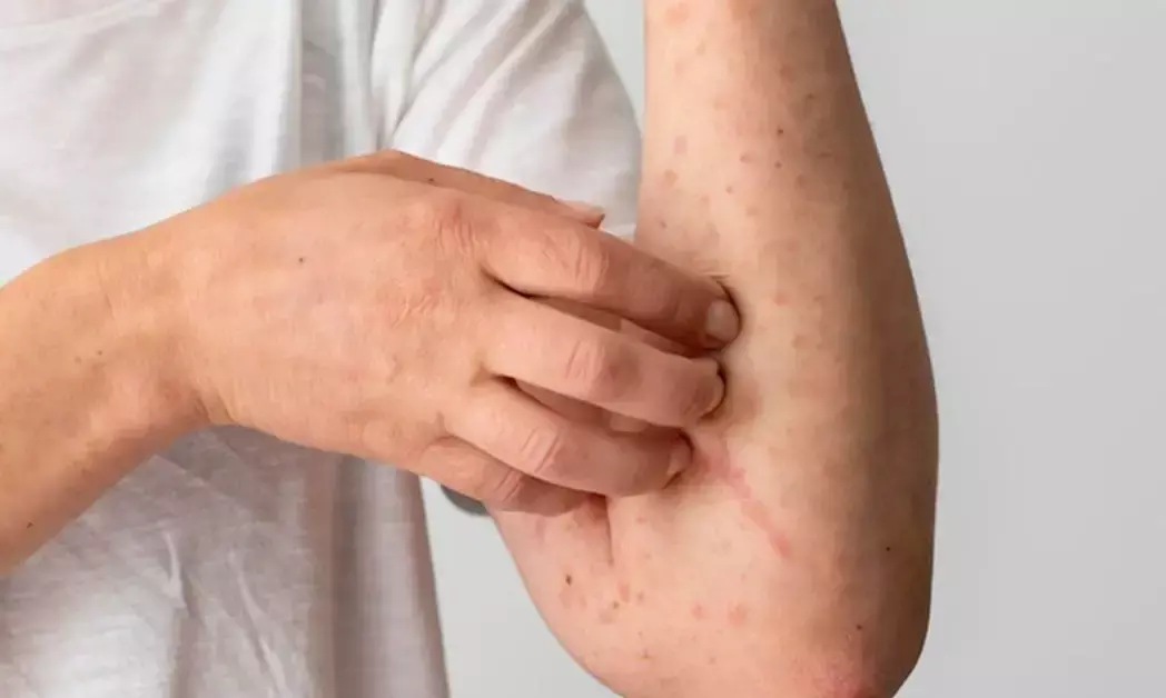 CM Naidu directs officials to educate public on scrub typhus, clarifies it’s not contagious