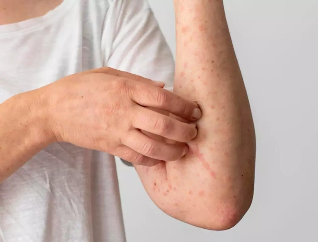 CM Naidu directs officials to educate public on scrub typhus, clarifies it’s not contagious