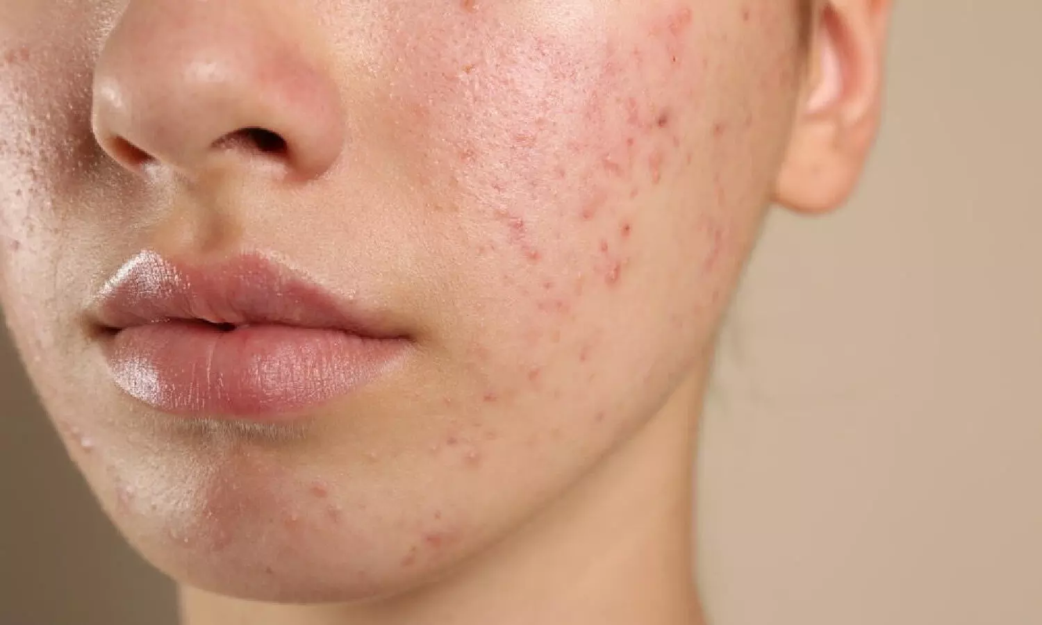 The acne burden: Dermatologists across India report steady rise in cases among young adults The acne burden: Dermatologists across India report steady rise in cases among young adults