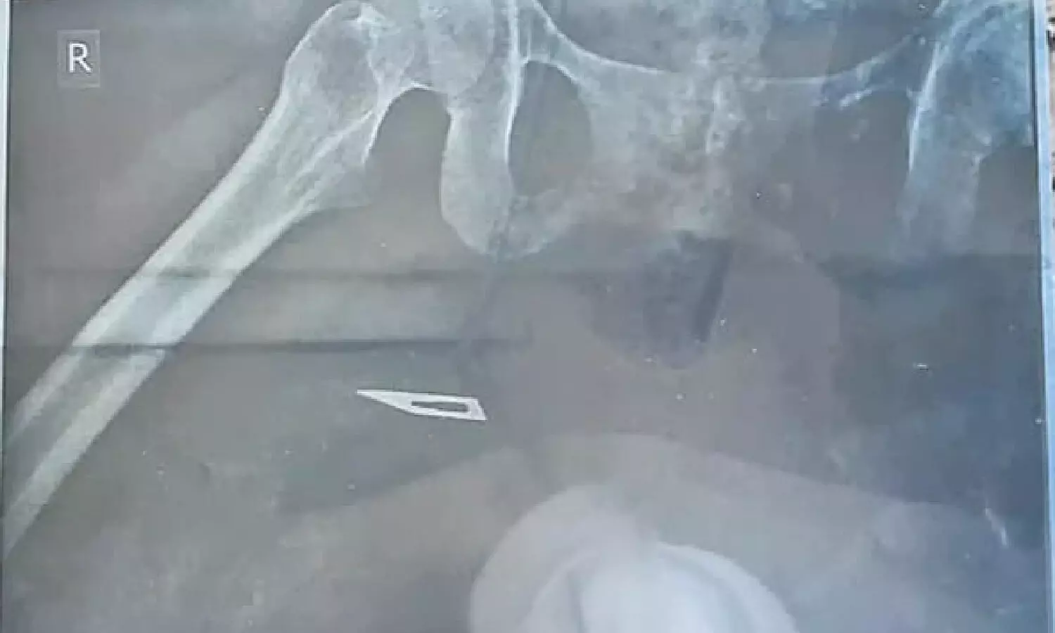 Doctors leave blade in woman’s thigh during surgery at GH, Narasaraopet; 5 suspended