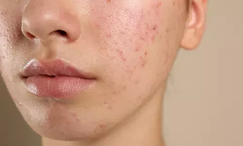 The acne burden:  Dermatologists across India report steady rise in cases among young adults