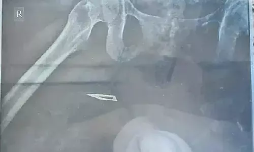 Doctors leave blade in woman’s thigh during surgery at GH, Narasaraopet; 5 suspended