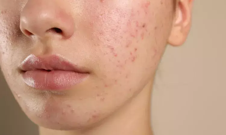 The acne burden:  Dermatologists across India report steady rise in cases among young adults