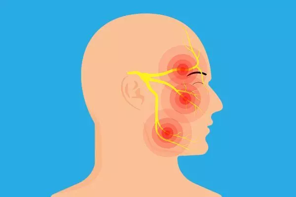 Trigeminal neuralgia: Why severe facial pain is often misdiagnosed Trigeminal neuralgia: Why severe facial pain is often misdiagnosed