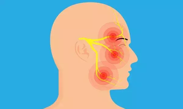 Trigeminal neuralgia: Why severe facial pain is often misdiagnosed Trigeminal neuralgia: Why severe facial pain is often misdiagnosed