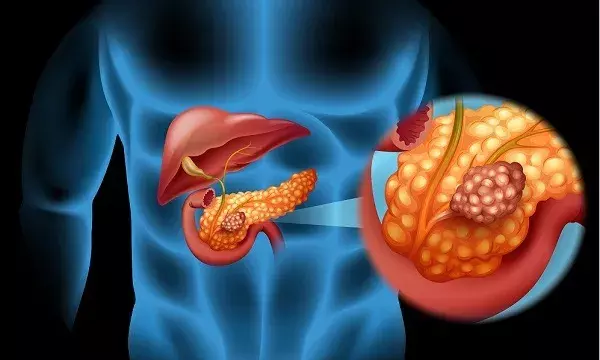 Two-stage treatment at KIMS Kondapur saves techie with pancreatic neuroendocrine tumour