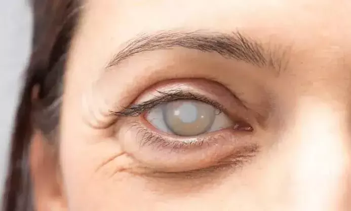 62.6% blindness cases in Telangana due to cataract; refractive errors and glaucoma follow