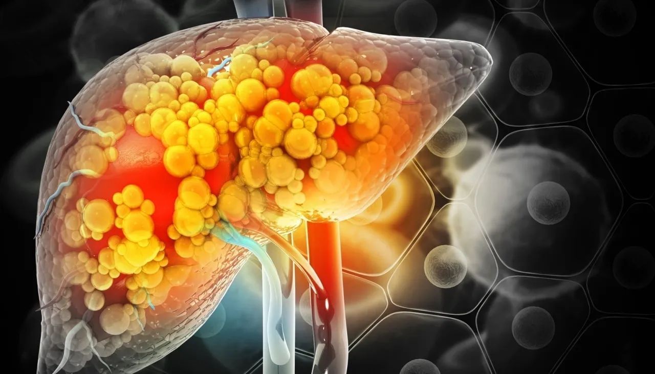 What it Metabolic Dysfunction-Associated Steatotic Liver Disease?