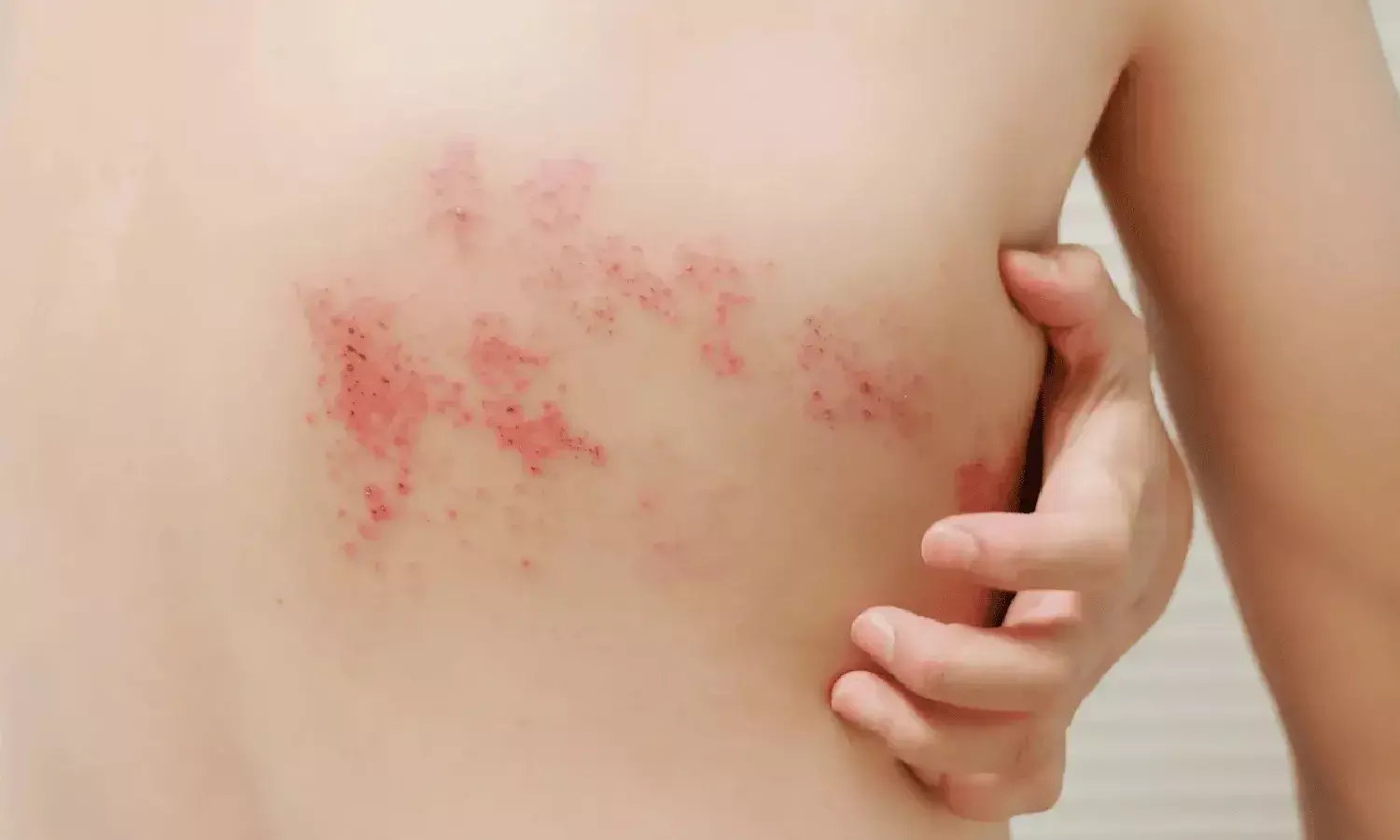 Shingles Awareness Week:  Causes, symptoms, prevention, and treatment of painful infection