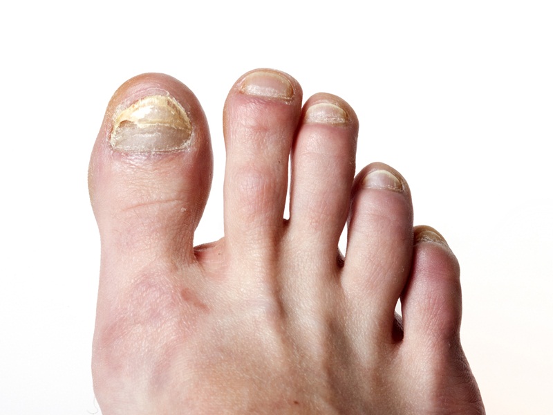 How to get rid of nail fungus | Edward-Elmhurst Health