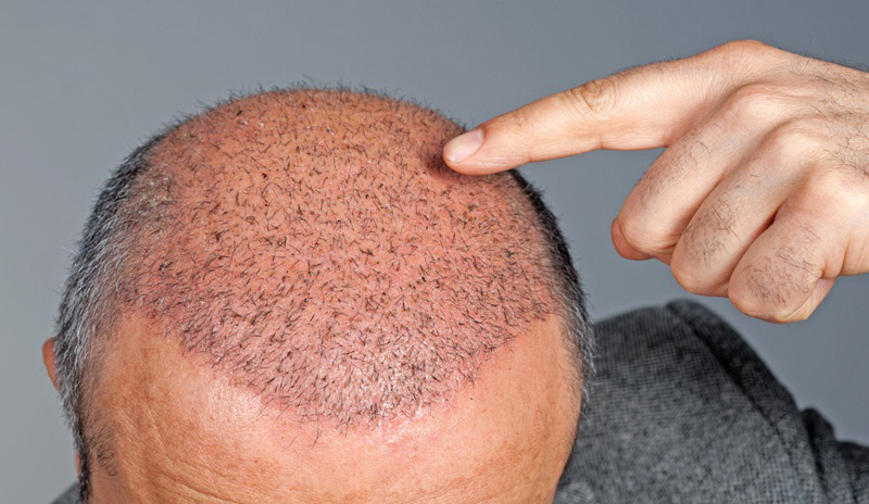 Advanced Hair Transplantation In Hyderabad